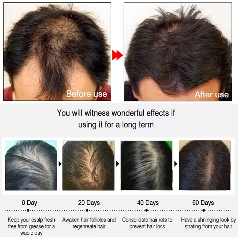 Ginger Hair Growth spray Anti  - Hair Care For Hair Loss recensione e prezzo